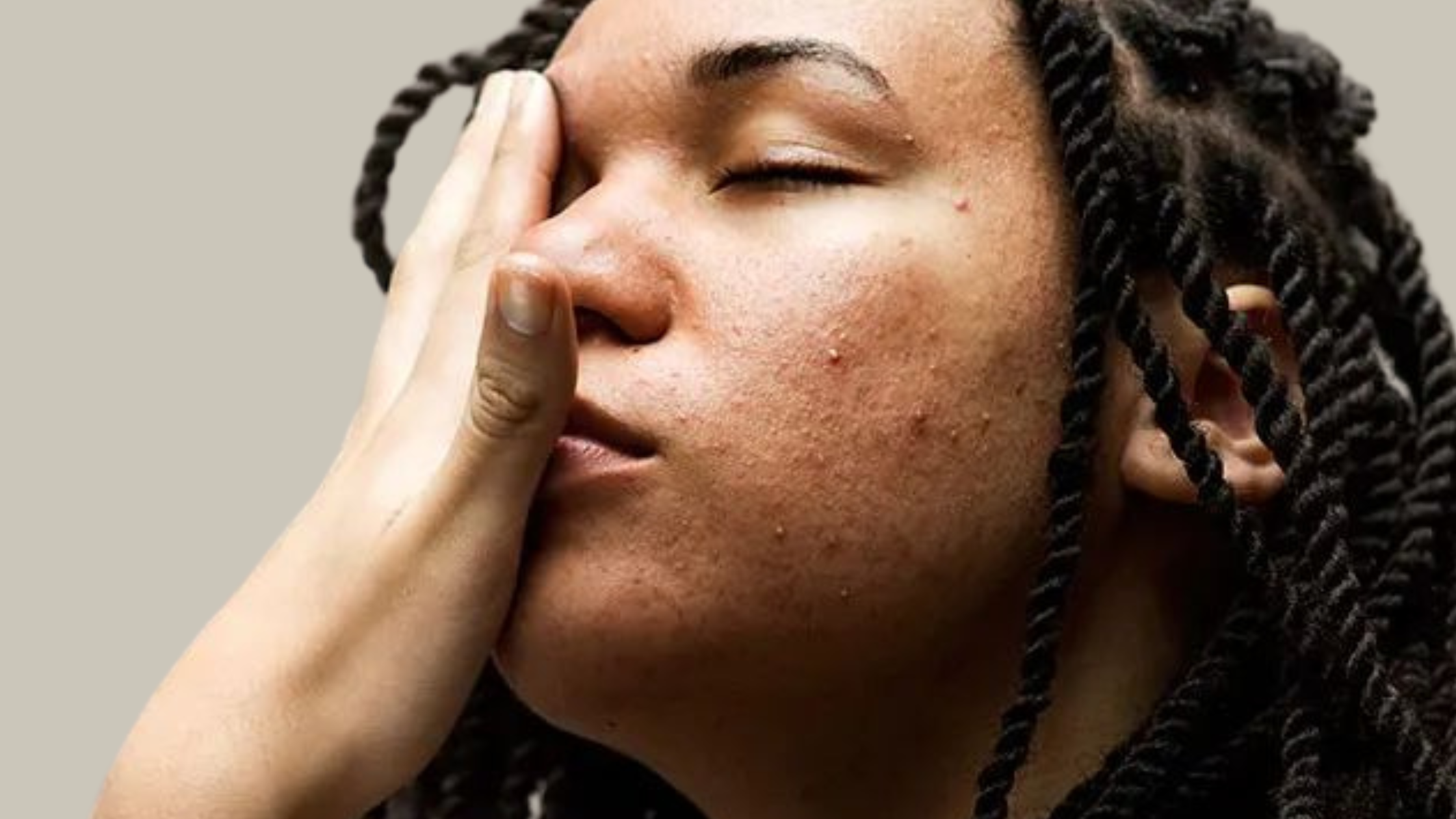 The Myth Is True: Winter Can Trigger Acne