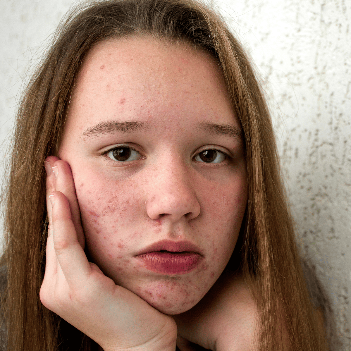 How to treat teenage girl acne — the gentle 3-step routine, safe from age 11