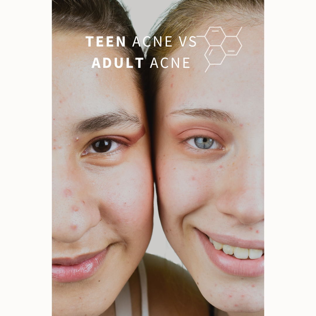 Teen Acne vs. Adult Acne