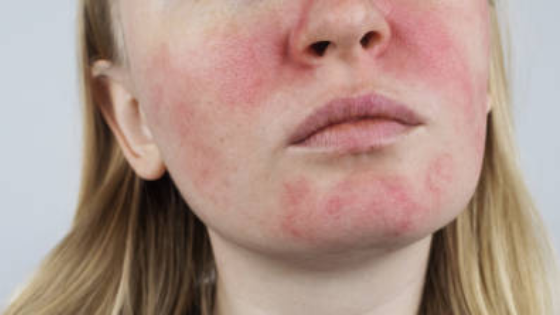 Understanding Perioral Dermatitis: How to Manage & De-Stress