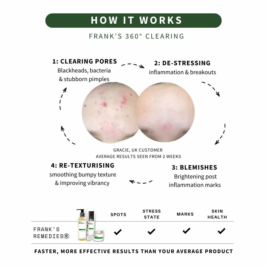 Diagram explaining Frank's 360° Clearing process "how it works" with before and after skin comparisons - Ready Steady Clear Kit